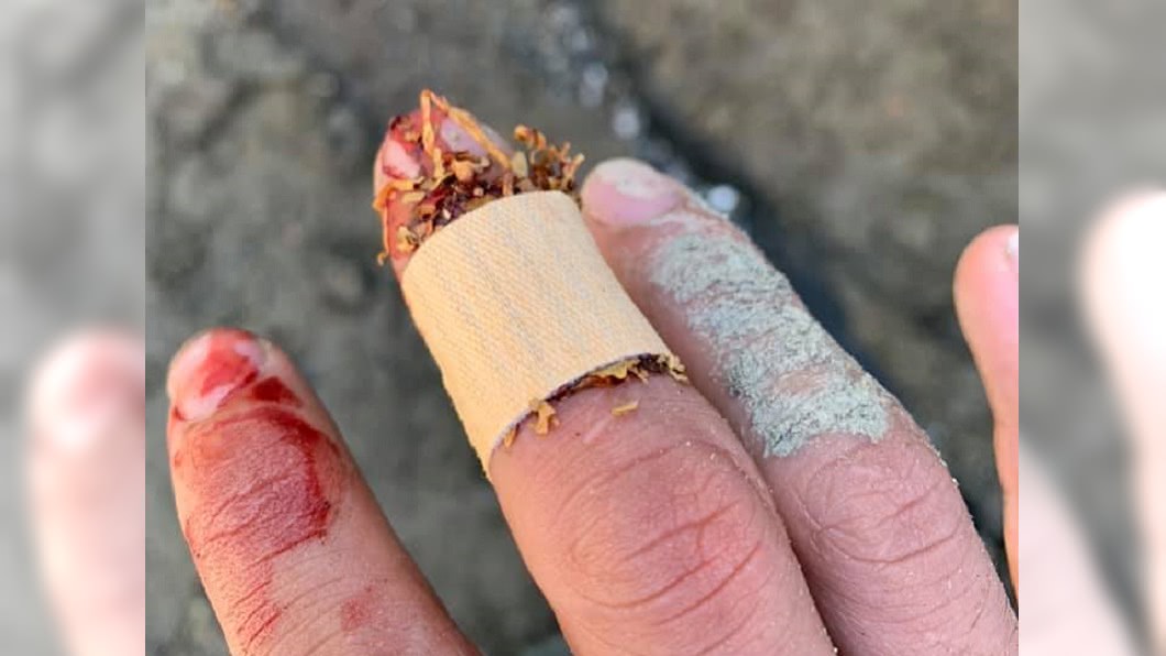 網友PO出自己受傷用菸草止血的照片,表示真的可以止血。圖/翻攝爆系知識家臉書