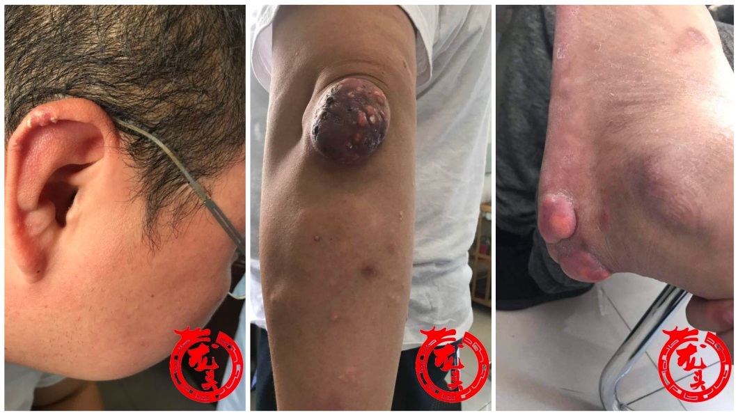 男子全身上下長滿痛風石,至少上千顆,讓人看了怵目驚心。(圖/翻攝自龍頭新聞)