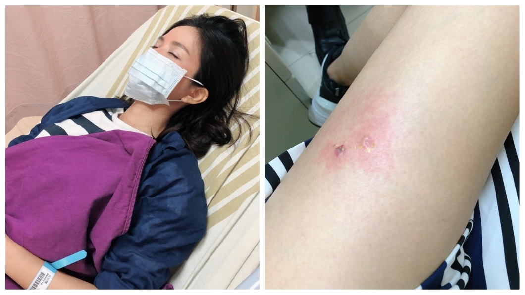 女星吳怡霈近日趕拍新戲卻得了流感，腿部還遭蚊蟲咬傷紅腫。(圖／翻攝自臉書)