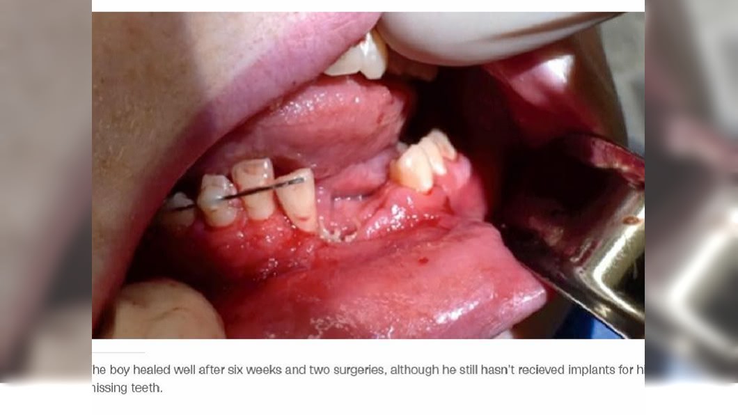美國一名少年在抽電子菸時突然在他口中爆炸，造成他牙齒被炸飛好幾顆，下巴也因此碎裂。(圖／翻攝自CNN)