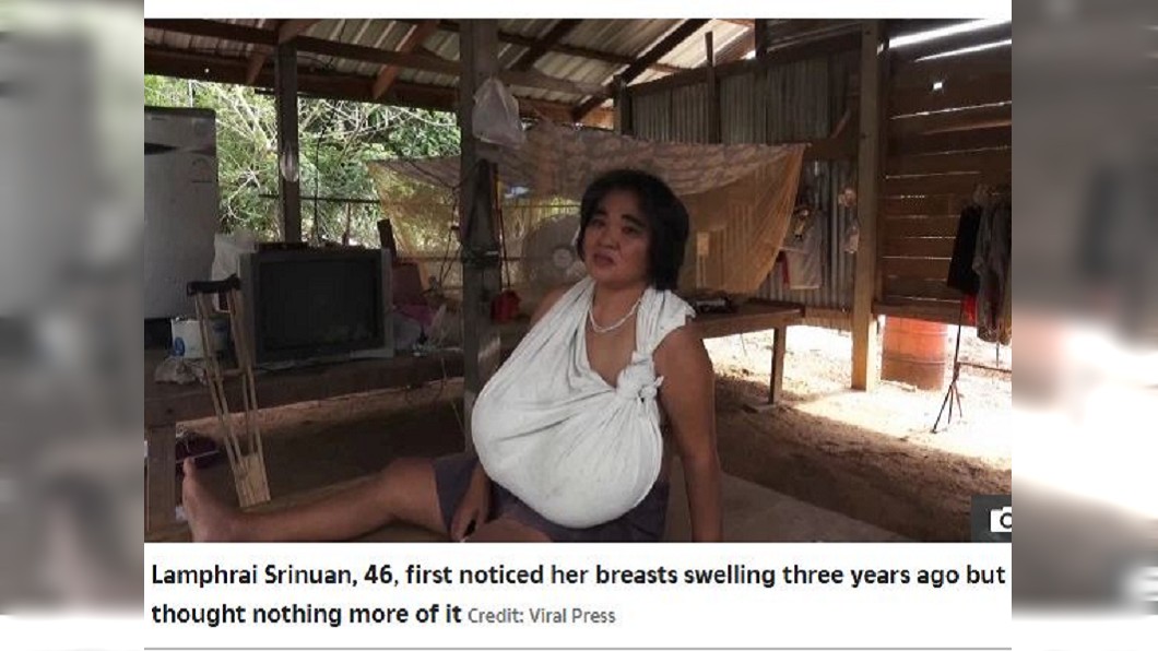泰國一名46歲的女子胸部突然異常增大,甚至已經比她的頭部還大了。(圖/翻攝自太陽報)