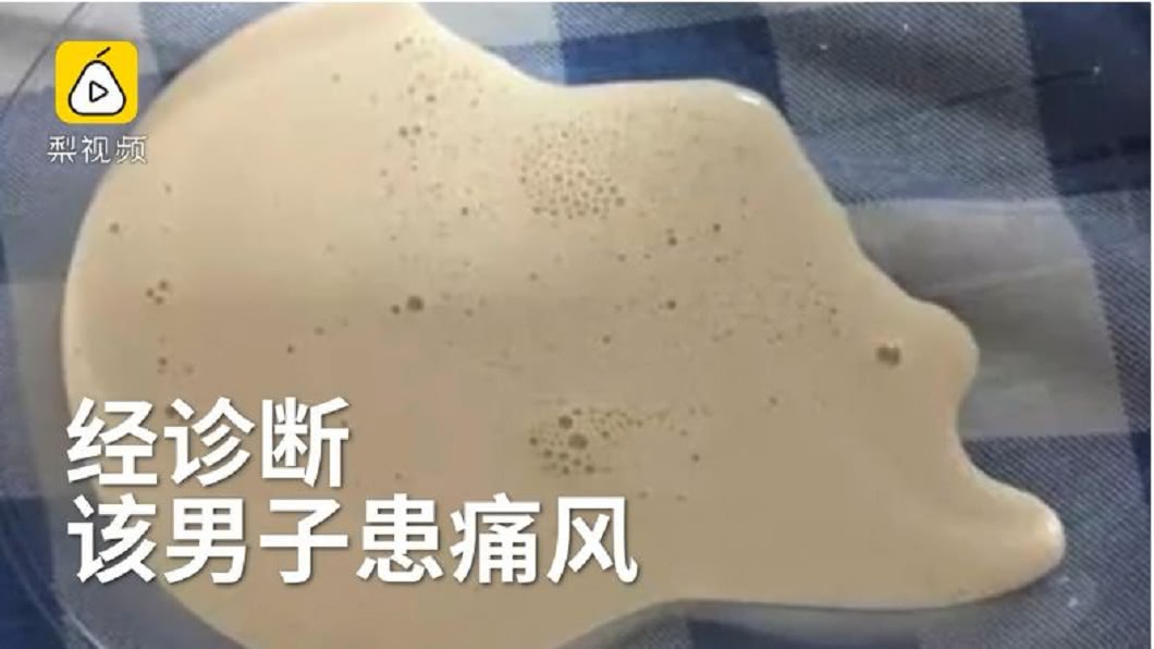 男子抽出來的卻呈現乳白色,經診斷尿酸過高,罹患痛風了。(圖/翻攝自梨視頻)