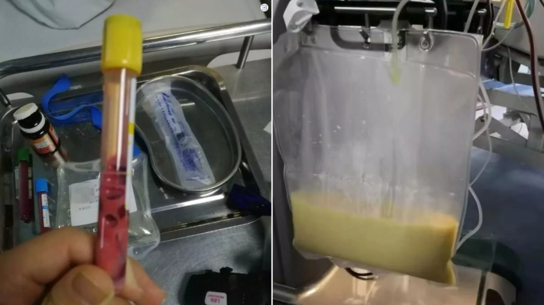 少女的血液呈粉紅色、更抽出多達8000毫升的乳白色脂肪液。圖/微博