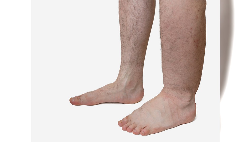 男子左腳水腫，竟是腫瘤引起。示意圖／TVSB