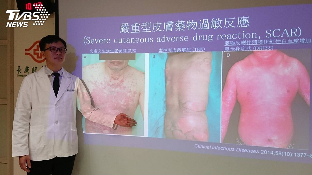 圖／中央社 2成台灣人有特殊基因　磺胺藥過敏風險高逾40倍