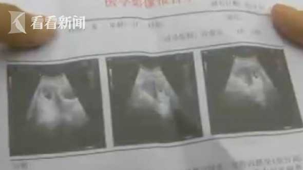 婦人在手術後1星期感到身體不適,再度前往醫院複查,沒想到胎兒竟還在腹中。(圖/翻攝自看看新聞)