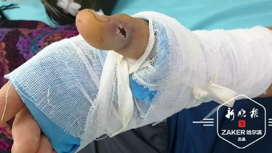 一名男子在泡藥酒時不慎被蛇咬傷口,急救後保住一命。(圖/翻攝自陸網)