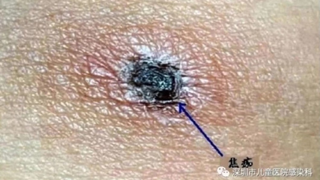 圖/翻攝深圳市兒童醫院感染科