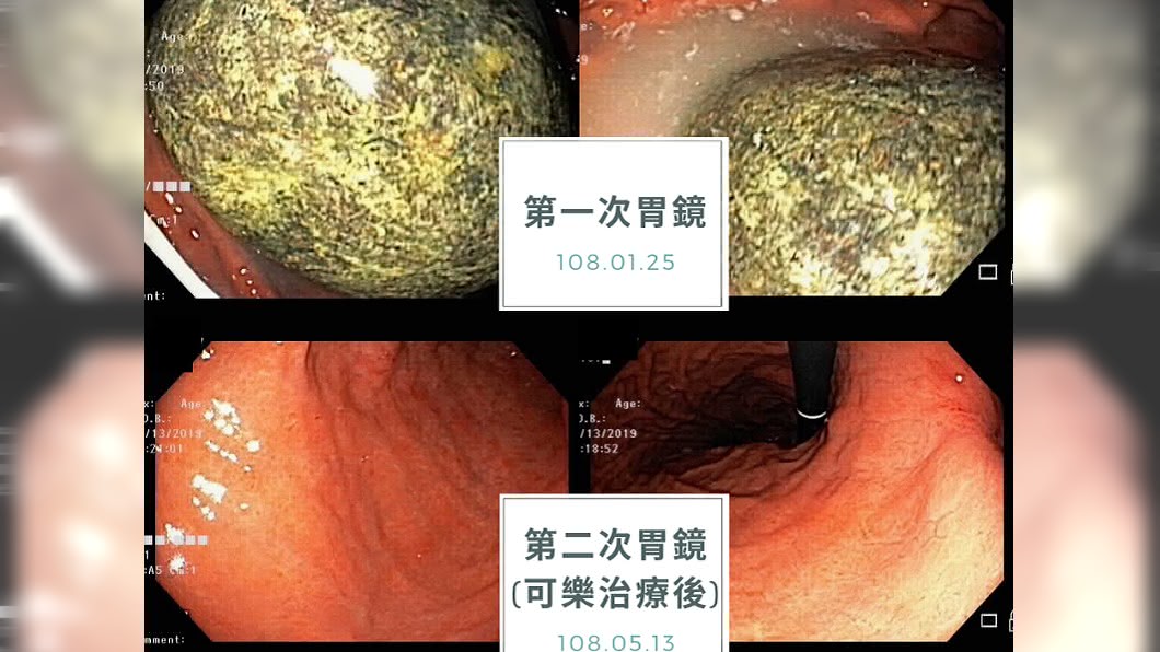 老翁喝可樂治療前後對照的胃鏡照片。圖/翻攝平安葉治威聯合診所臉書