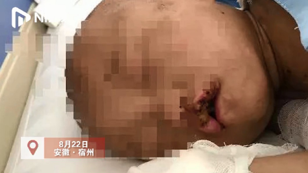 女童身體多處潰爛。圖/翻攝自N視頻