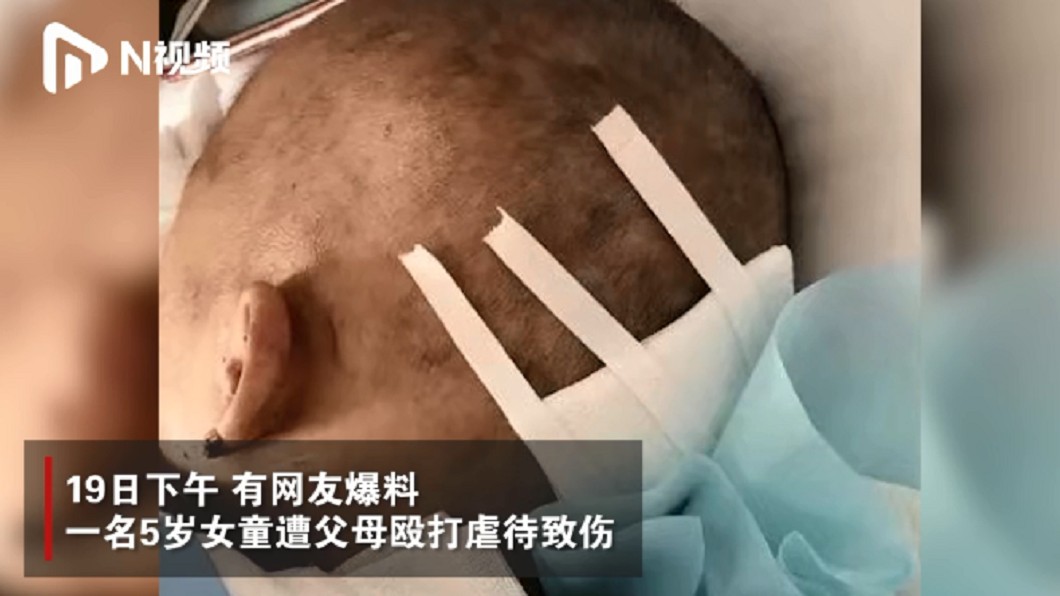 女童全身是傷。圖/翻攝自N視頻