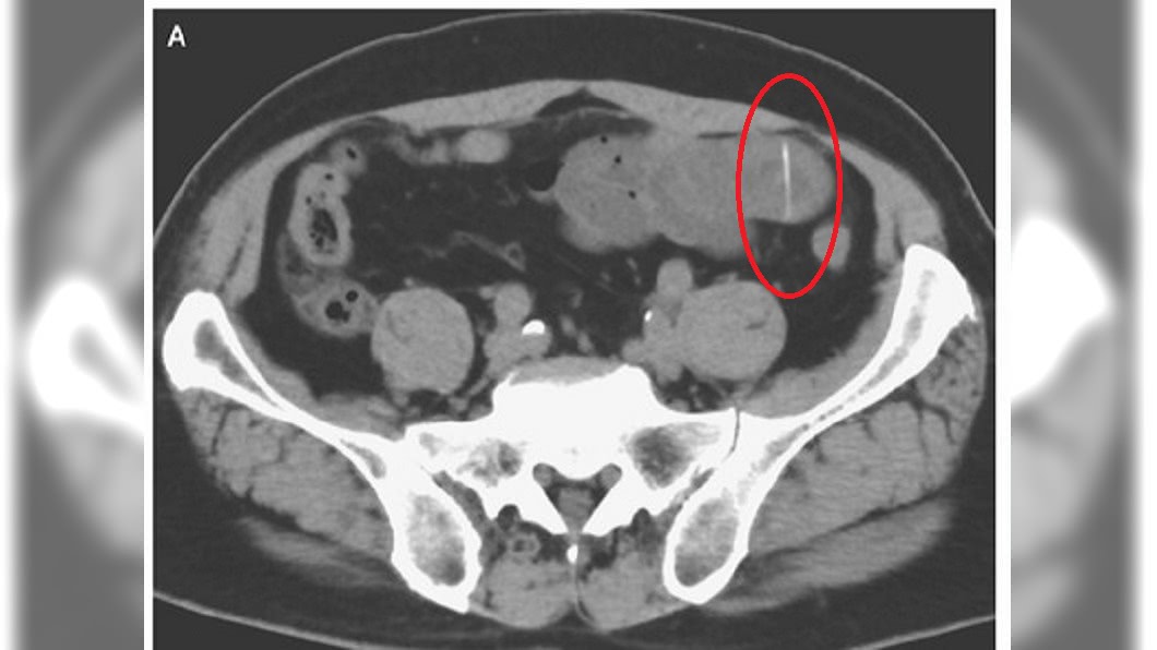 老翁腹部X光照片，明顯看到1根魚刺。圖／翻攝The New England Journal of Medicine
