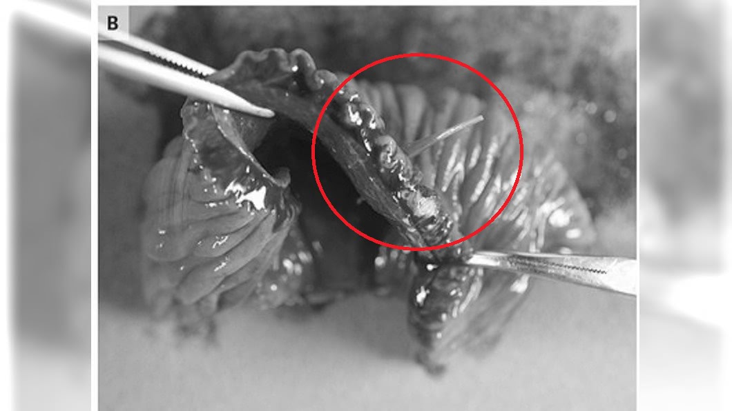 老翁的部份小腸,跟著魚刺一起被切除。圖/翻攝The New England Journal of Medicine