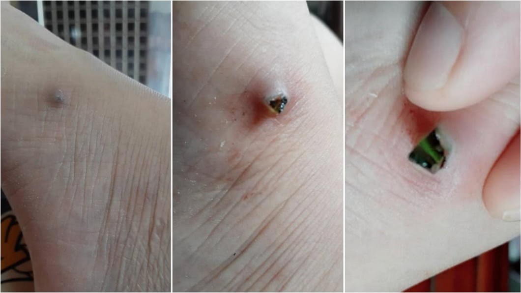 原PO貼出一步一步「擠玻璃」照片,讓人看了怵目驚心。圖/翻攝爆怨公社臉書