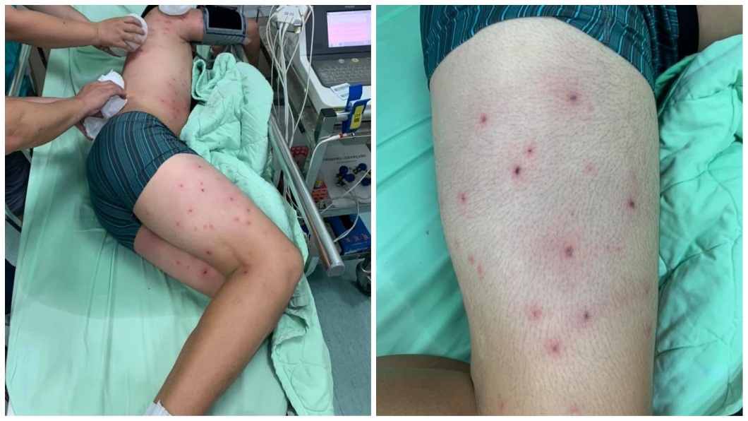 受傷少年全身上下遭虎頭蜂螫出上百處傷口。(圖/翻攝自「線西風之鄉」臉書粉絲團)
