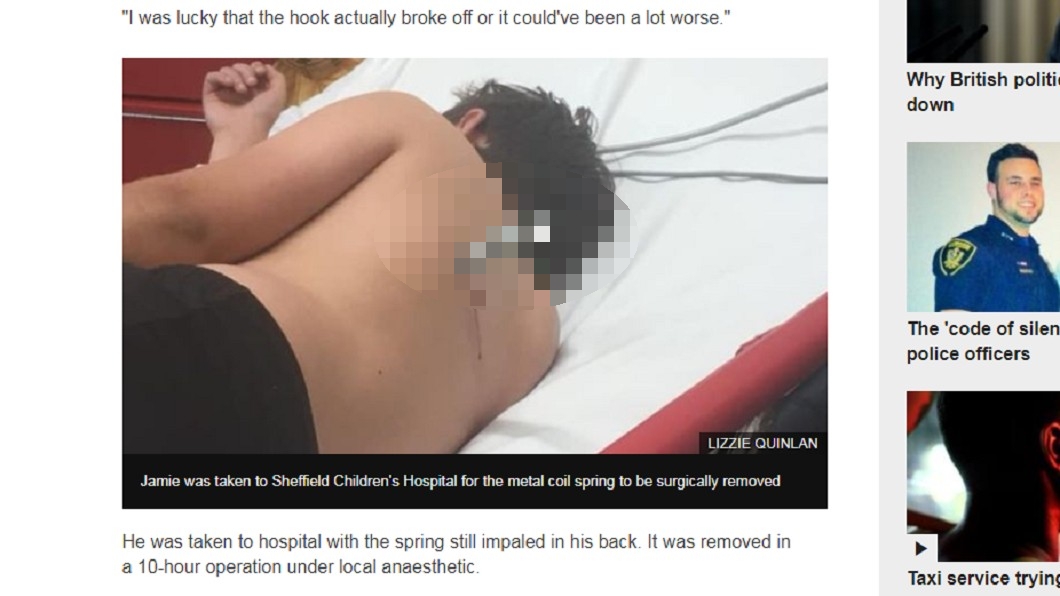 彈簧直插小男孩背部。圖／翻攝至BBC NEWS網站