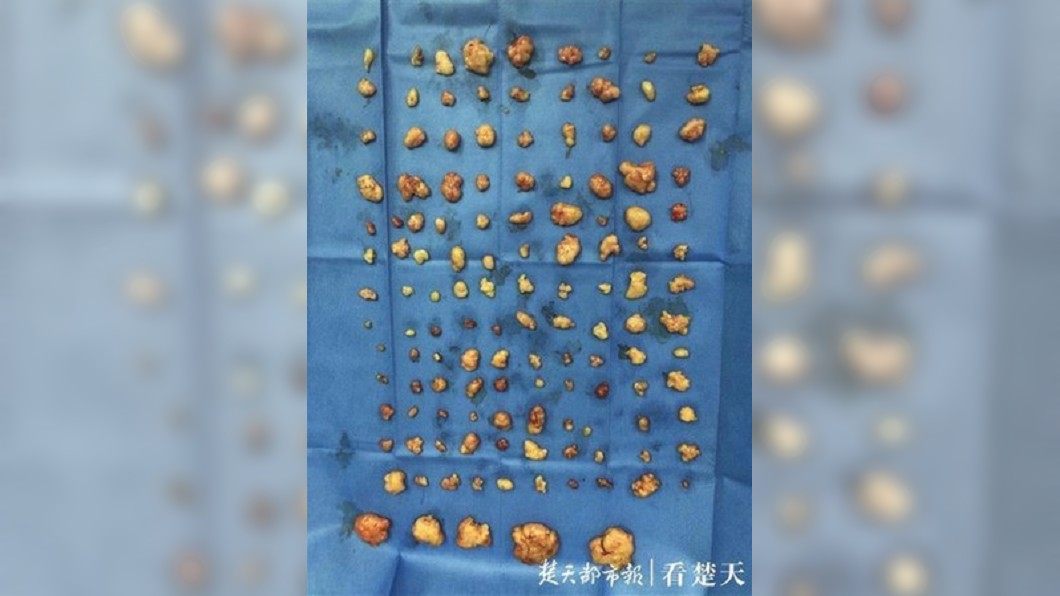 湖北1名婦人長期熬夜打麻將長達5年,身上長出超過200顆大小不一的脂肪瘤。(圖/翻攝自楚天都市報)