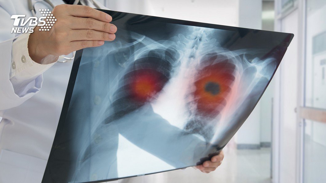 肺癌標靶新藥讓存活期破3年。(示意圖／TVBS)