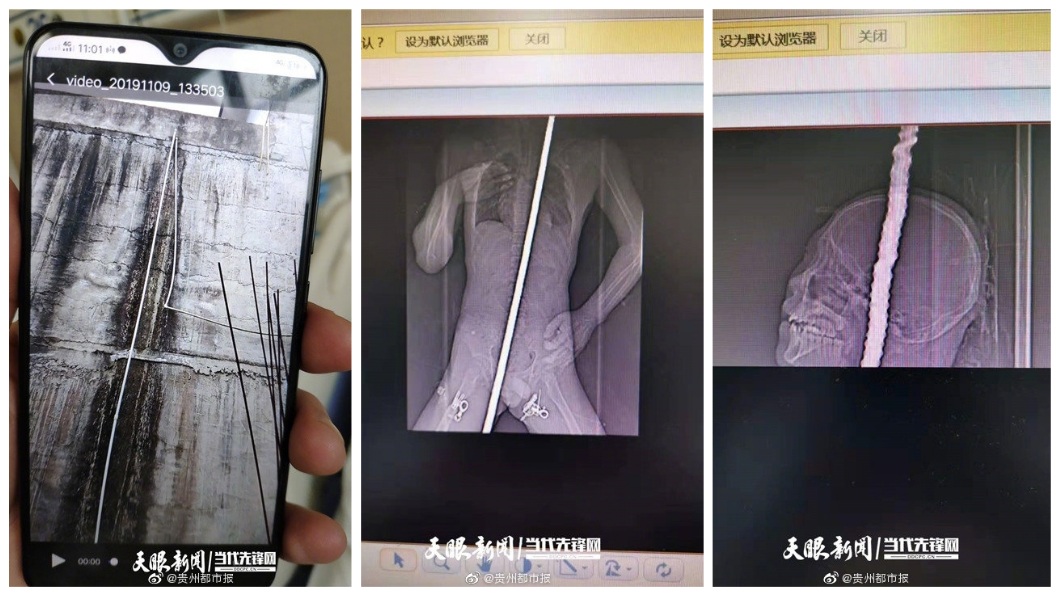 醫師說男孩因為當時心臟收縮,幸運地保住一命。(圖/翻攝自微博)