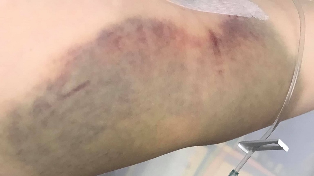 英國1名22歲的嫩媽，日前發現自己手臂上莫名出現了大片瘀青。(圖／翻攝自GoFundMe網站)