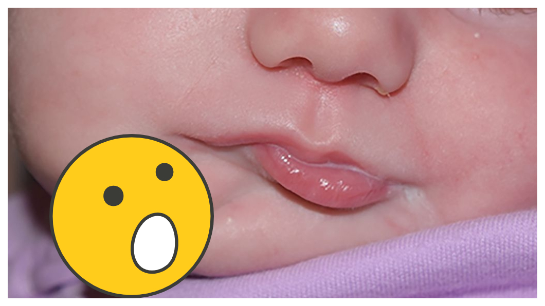 女嬰天生就有兩張嘴 (圖／翻攝自British Medical Journal) 罕見！女嬰天生有「2張嘴」　吃東西2舌頭竟同時動