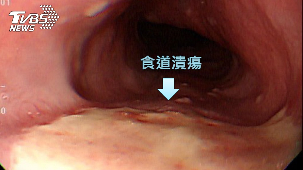男子吐司卡喉引起食道潰瘍。（圖／安南醫院許秉毅醫師提供）