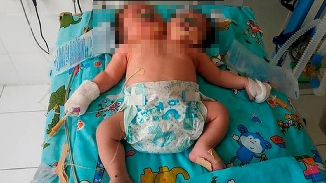 烏茲別克一名女子生下雙頭嬰。（圖／翻攝自sof.uz） 誇張！產檢建議拿掉　公公逼生「雙頭嬰」喊：國家養