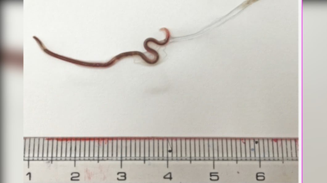 夾出狂蠕動 女嗜吃生魚片4公分寄生蟲藏喉嚨 腸胃 日式料理 偽地新線蟲 Tvbs新聞網 夾出狂蠕動 女嗜吃生魚片4公分寄生蟲藏喉嚨 腸胃 日式料理 偽地新線蟲 Tvbs新聞網