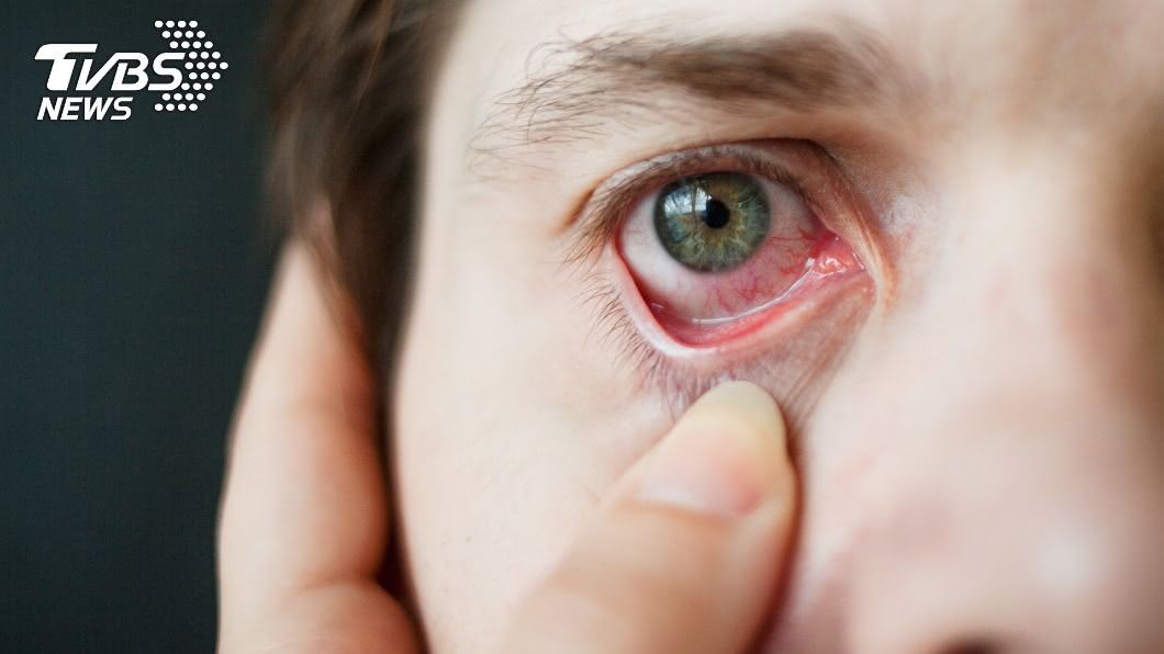 眼科醫師指出，眼周壓力大可能造成顏面神經失調。（示意圖／shutterstock達志影像）