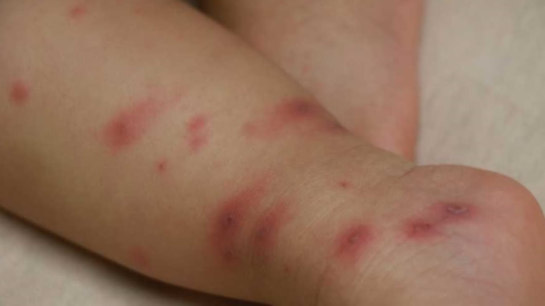 女嬰高燒冒紅疹，竟是被爸爸傳染水痘病毒。（圖／翻攝自台中慈濟醫院官網）