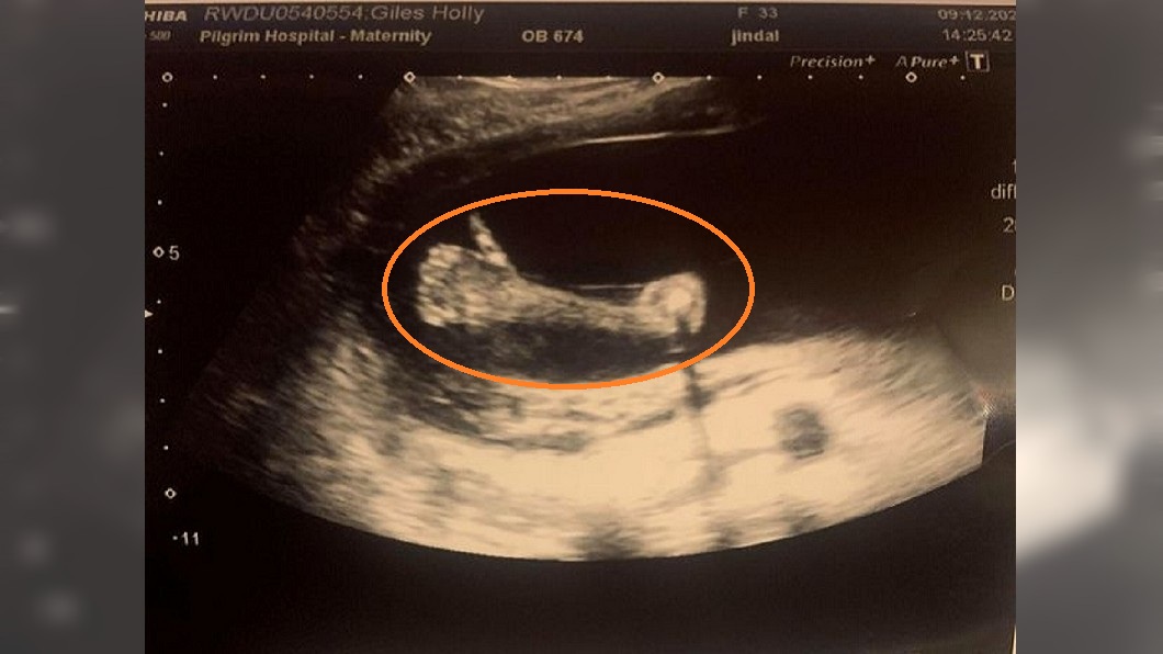 英國一名孕婦日前去進行產檢，照超音波時看見腹中胎兒比讚，讓她驚呼連連。（圖／翻攝自推特）