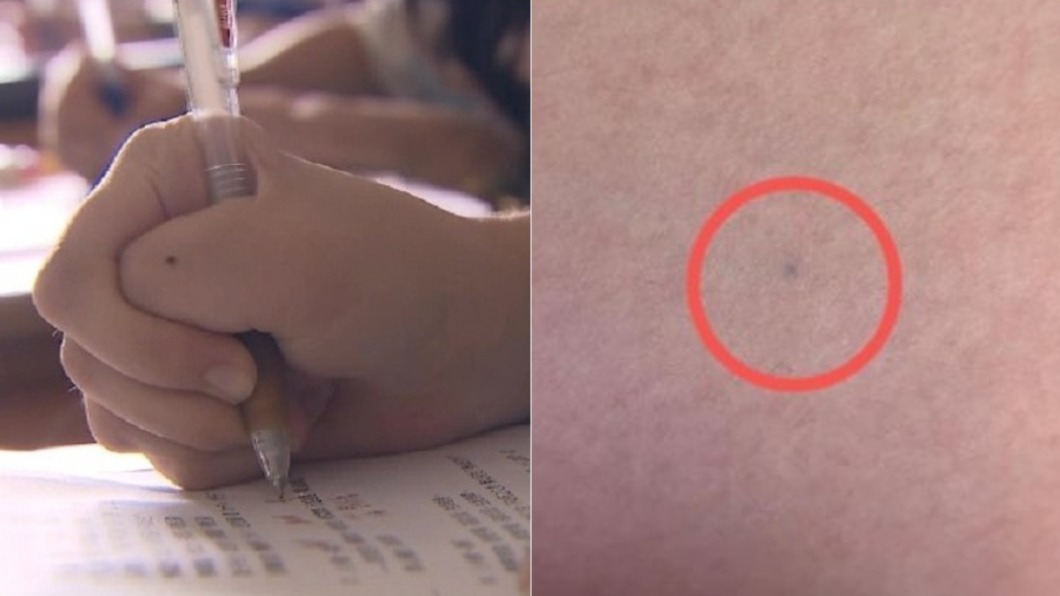 女子皮膚上的「黑痣」其實是鉛筆筆芯。（圖／TVBS資料畫面、翻攝自臉書社團「爆廢公社」）