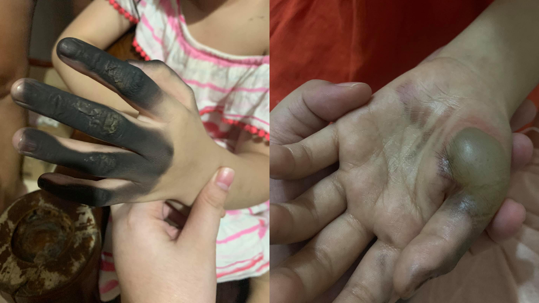 插頭突然爆炸，7歲女童手指被燒成焦黑。（圖／翻攝自Athena Quintana Comboy臉書）
