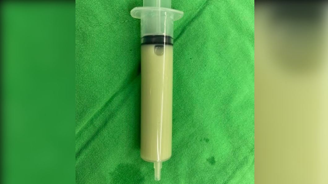 醫師從婦人體內抽出一大管「抹茶色」膿尿。（圖／翻攝自Dr.邱的泌尿健康與旅遊筆記臉書）