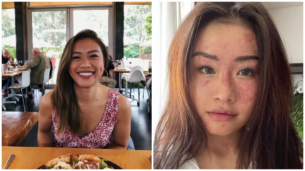 新加坡一名23歲的女子日前因為一場意外導致毀容。（合成圖／翻攝自IG）
