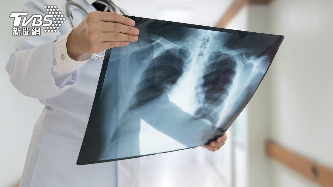 食藥署核准一款AI人工智慧偵測新冠肺炎患者的X光片。（示意圖／shutterstock達志影像）