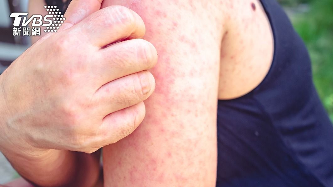 蕁麻疹發作會讓人癢得難以入眠。（示意圖，非當事人／Shutterstock達志影像）