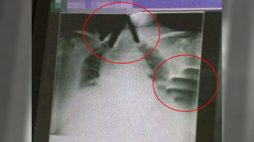 阿嬤X光片上有一雙手，緊掐著喉嚨與左胸。（圖／網友授權提供報導）