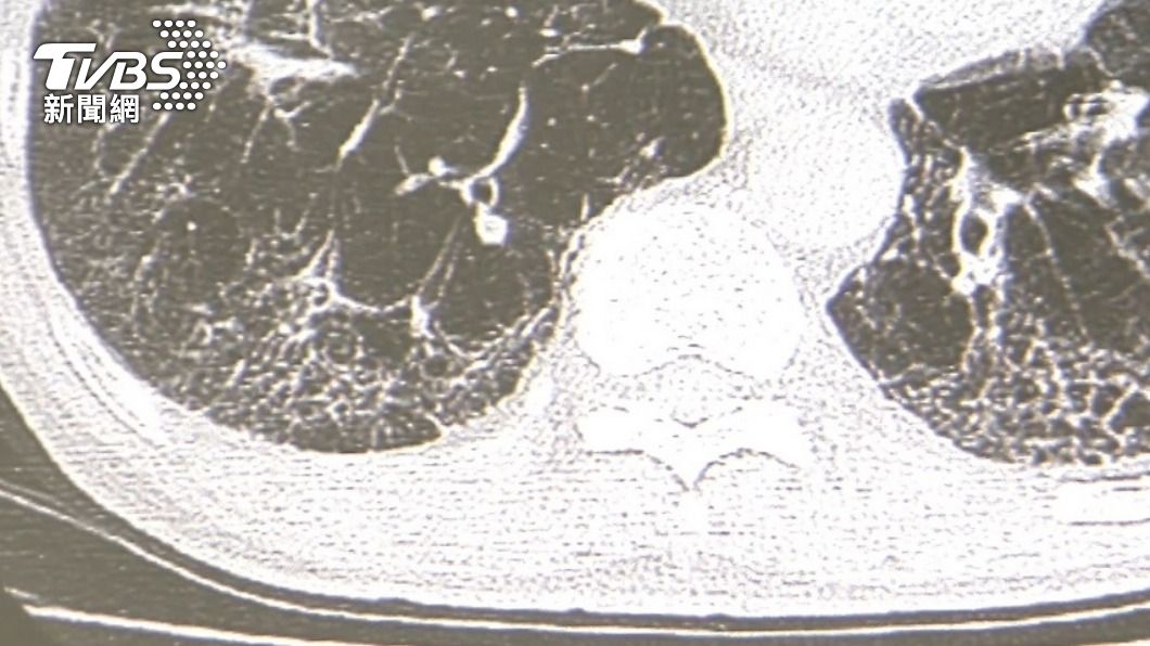新冠肺炎就算痊癒，也可能會有肺纖維化的後遺症。（圖／TVBS）