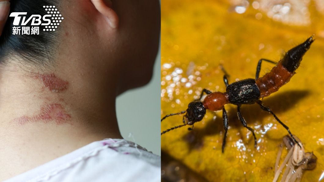 若在皮膚上打死隱翅蟲，容易引起皮膚潰爛。（示意圖／shutterstock達志影像）