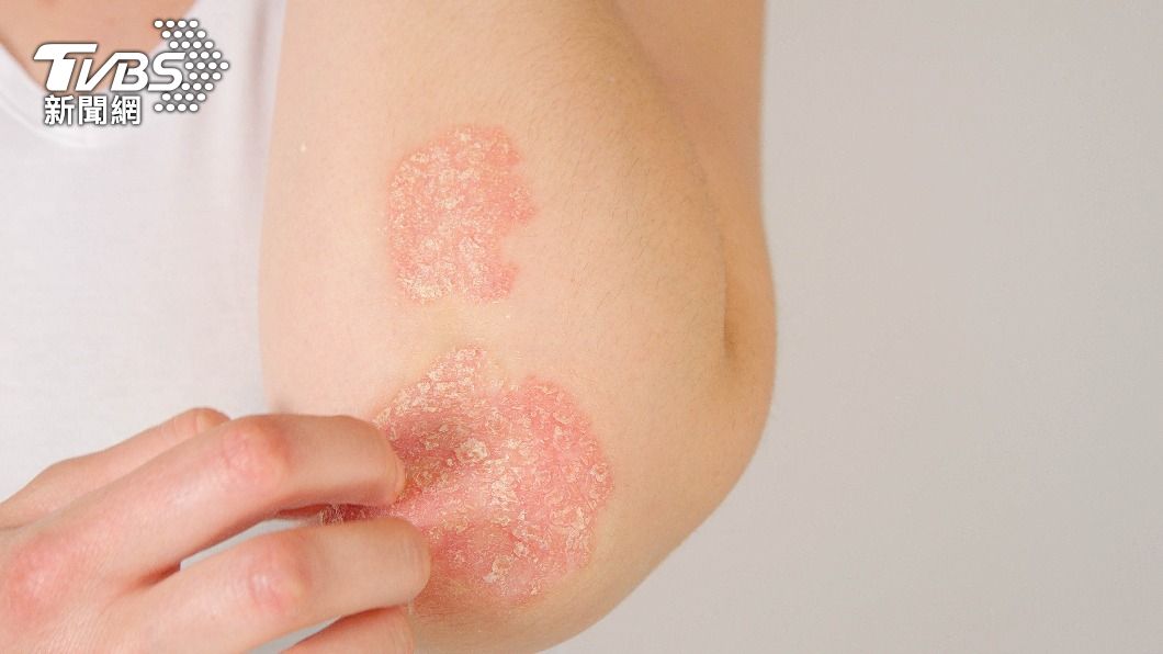 乾癬患者在夏天容易因流汗抓癢後導致病情惡化。（示意圖／shutterstock達志影像）