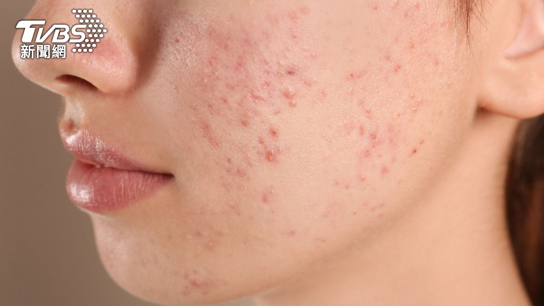 長粉刺、冒痘痘是肌膚常見問題。（示意圖，非本文當事人／shutterstock達志影像）
