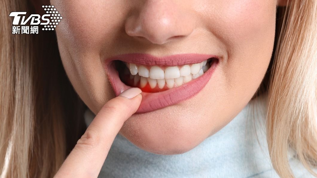 牙周病越來越嚴重，細菌移轉至喉嚨，進而成為癌症。（示意圖／shutterstock達志影像）