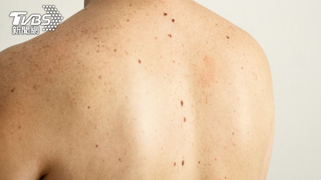 若身體皮膚的黑點出現特殊情況，宜盡早就醫檢查。（示意圖／shutterstock達志影像）