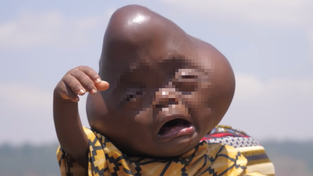 盧安達一名男嬰生來就頭部畸形，網友發起募款盼能讓他出國接受治療。（圖／翻攝自Afrimax English YouTube）