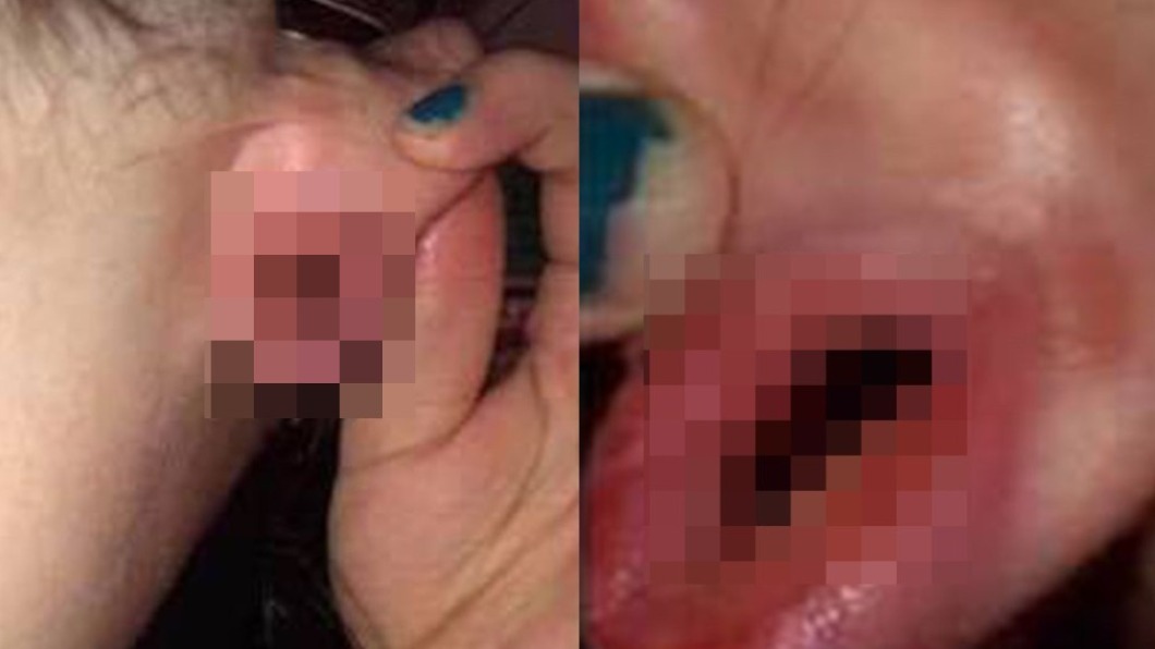 美國女子的耳洞被男友生殖器穿過後發炎。（圖／翻攝自臉書）