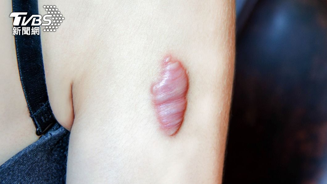 蟹足腫的疤痕外觀會明顯突起，反覆發作令人不勝其擾。（示意圖／shutterstock達志影像）