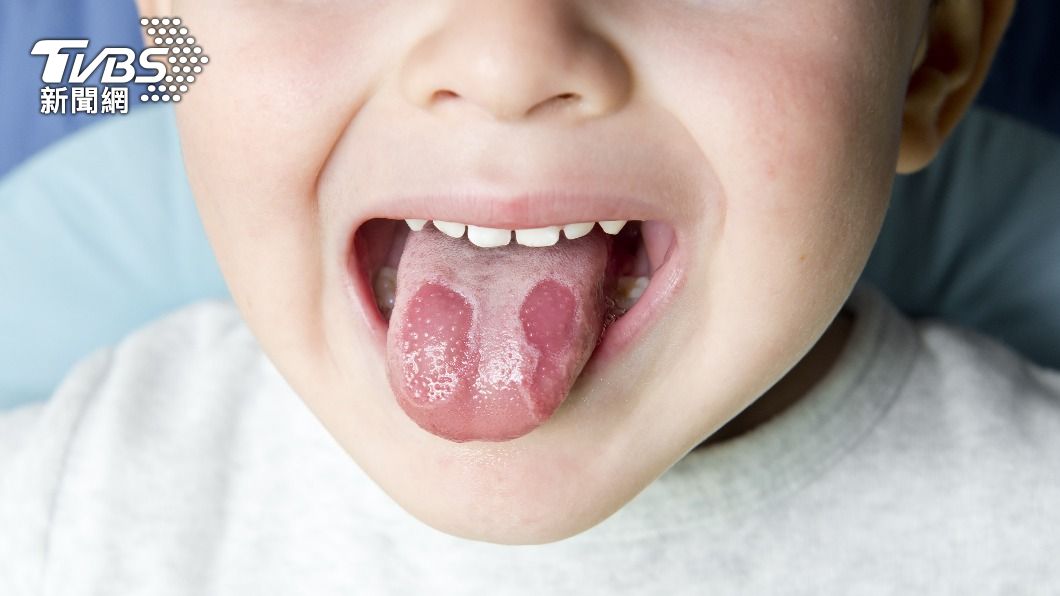 孩童若出現「地圖舌」，恐染上新冠肺炎。（圖／Shutterstock達志影像）