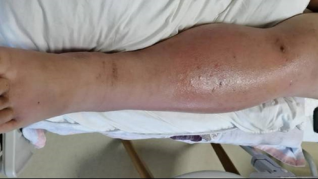 杭州一名孕婦出現左小腿腫脹的情況。（圖／翻攝自搜狐新聞）