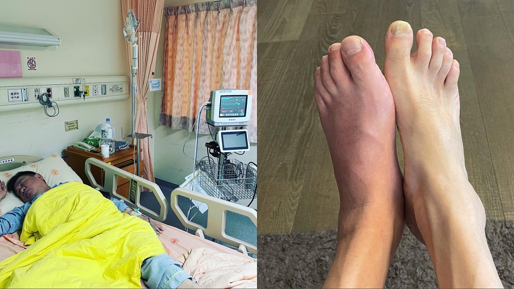 罹患膀胱癌的孫德榮，8月曾曬出左腳痛風發紅的照片。（圖／翻攝自孫腫來了臉書）
